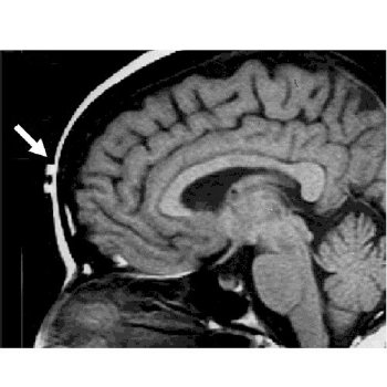 MRI Non-Magnetic Multi-Modality Markers